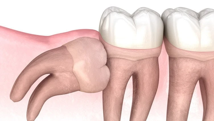 Chirurgija – Dantų Rovimas Domus Dentes klinikoje